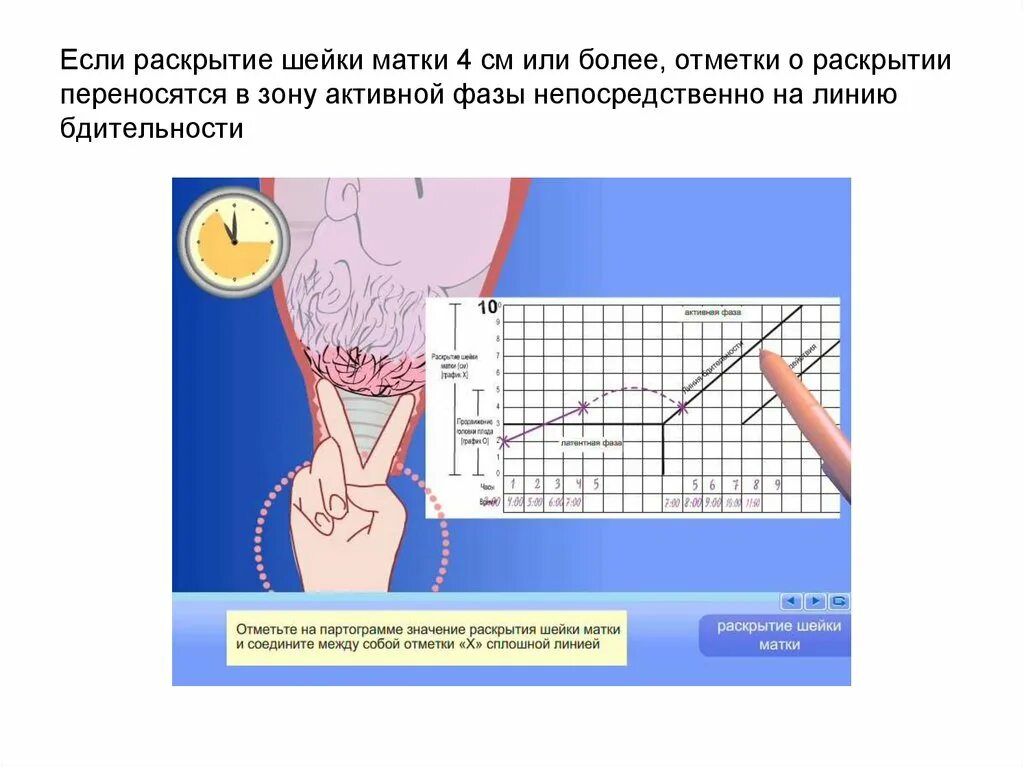 Этапы раскрытия шейки матки. Раскрытие шейки матки во время родов. Как проверяют раскрытие шейки матки. Шейка матки раскрытие. Беременность шейка 3