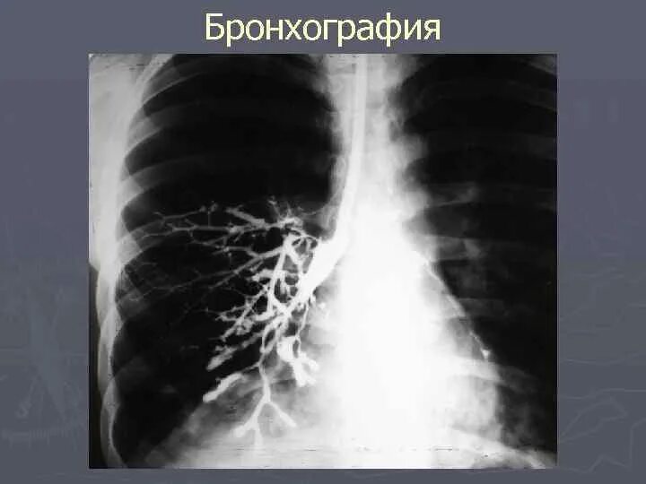 Контрастная рентгенография бронхов (бронхография). Бронхоэктатическая болезнь бронхография. Контрастная бронхография. Симптом воздушной бронхографии. Бронхография бронхоэктазов.