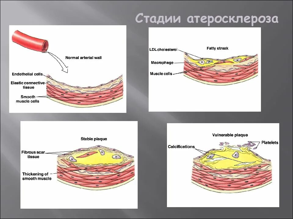 Стадии атеросклероза артерий. Долипидная стадия атеросклероза. периоды развития атеросклероза. стадия липоидоза атеросклероза. стадии формирования атеросклероза.