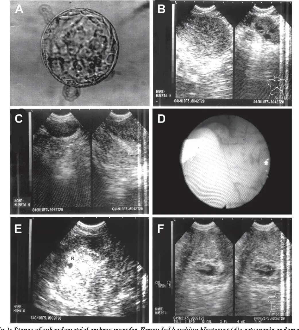 Эмбрион после пересадки. Матка и эмбрион после эко. Эмбрион 5 дней. Бластоциста имплантация. Эмбрион после имплантации.