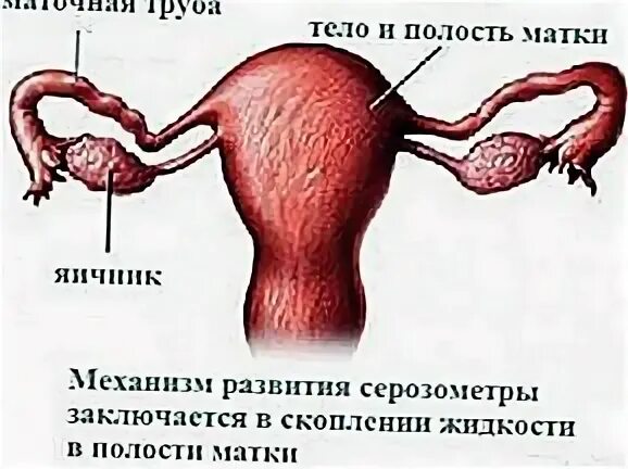 Лечение серозометра матки после 60