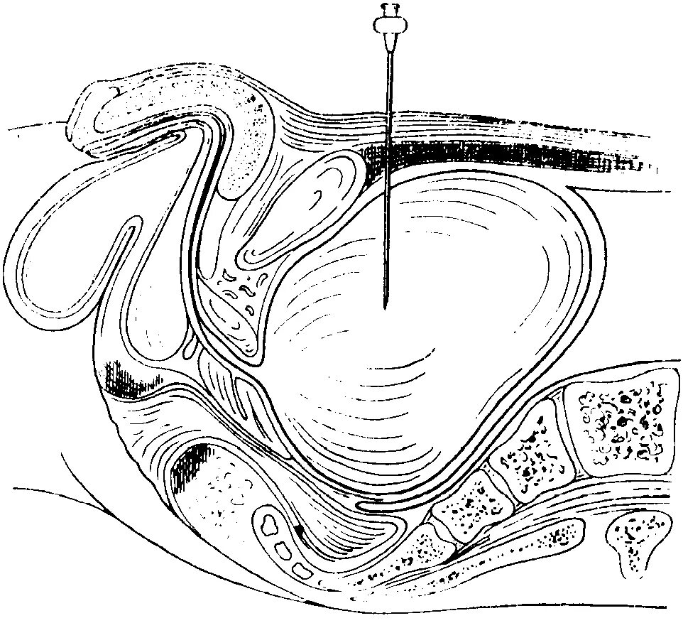 После мочевого. Пункция мочевого пузыря. Пункция мочевого пузыря техника. Пункция мочевого пузыря показания техника выполнения. Надлобковая пункция мочевого.