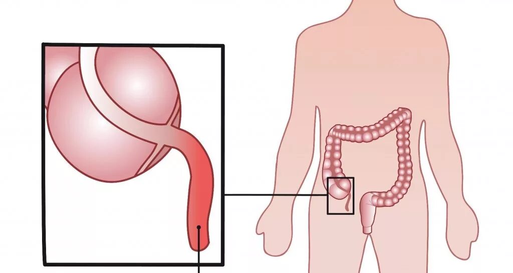 Где находится аппендицит у женщин с какой