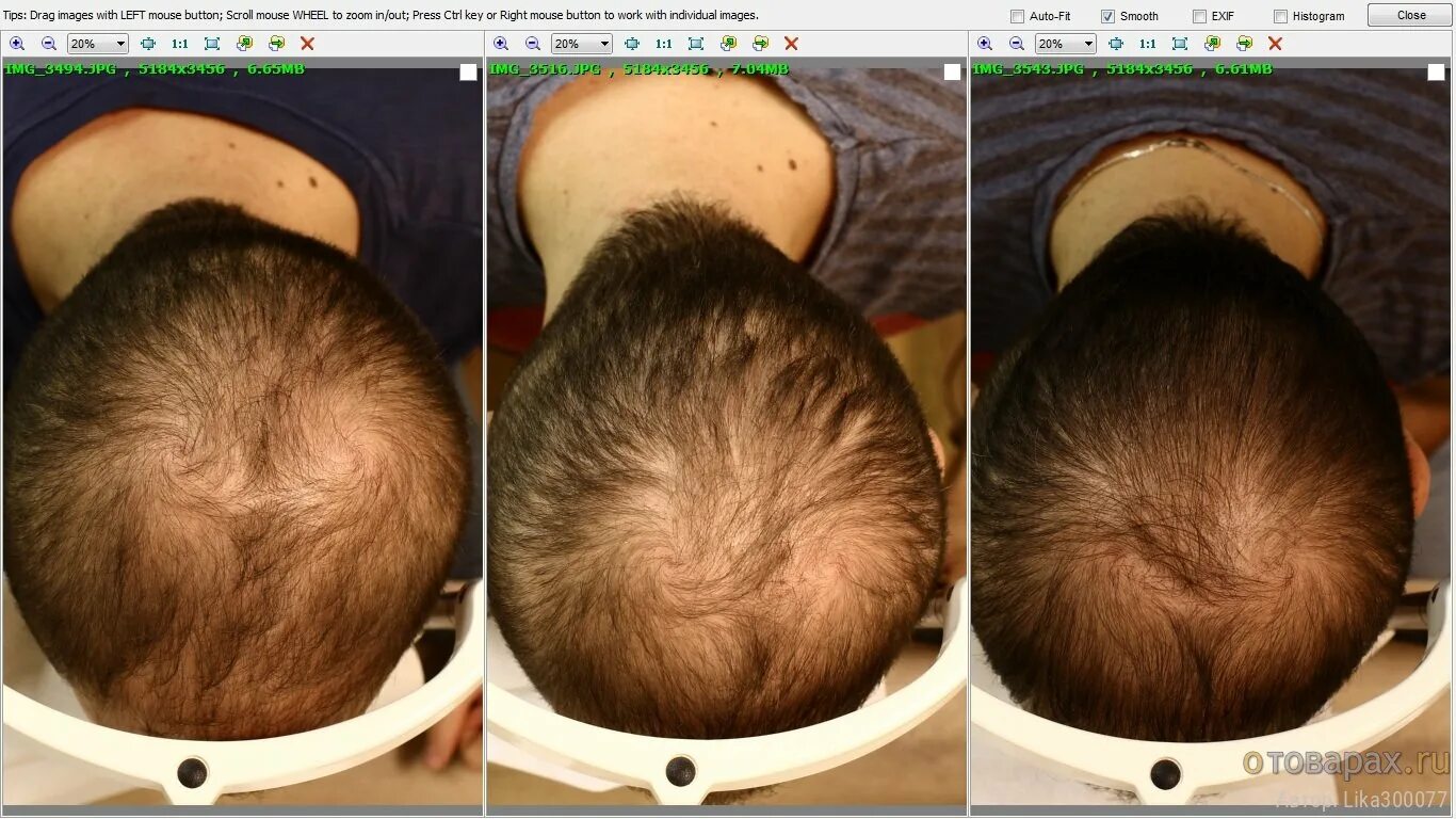 Эсвицин андрогенная алопеция. Дарсонваль алопеция до после. Андрогенная алопеция миноксидил. Андрогенная алопеция миноксидил. Дарсонваль при алопеции.