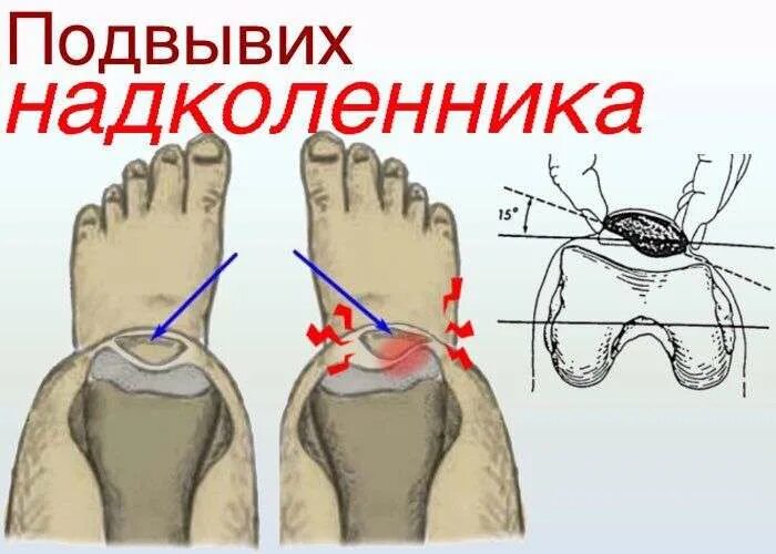 Латерализация надколенника. Вправление вывиха надколенника. Наружный подвывих надколенника. Латеральной гиперпрессии надколенника. Нестабильность надколенника.