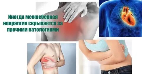 Межреберная невралгия грудного отдела симптомы лечение