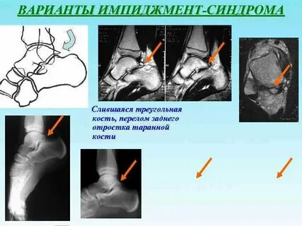 Задний импинджмент голеностопного