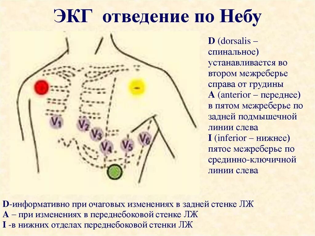 Грудные отведения на ЭКГ электроды. ЭКГ по небу и Слопаку наложение электродов. Наложение электродов при ЭКГ по небу. Методика отведения в ЭКГ. Правые грудные отведения