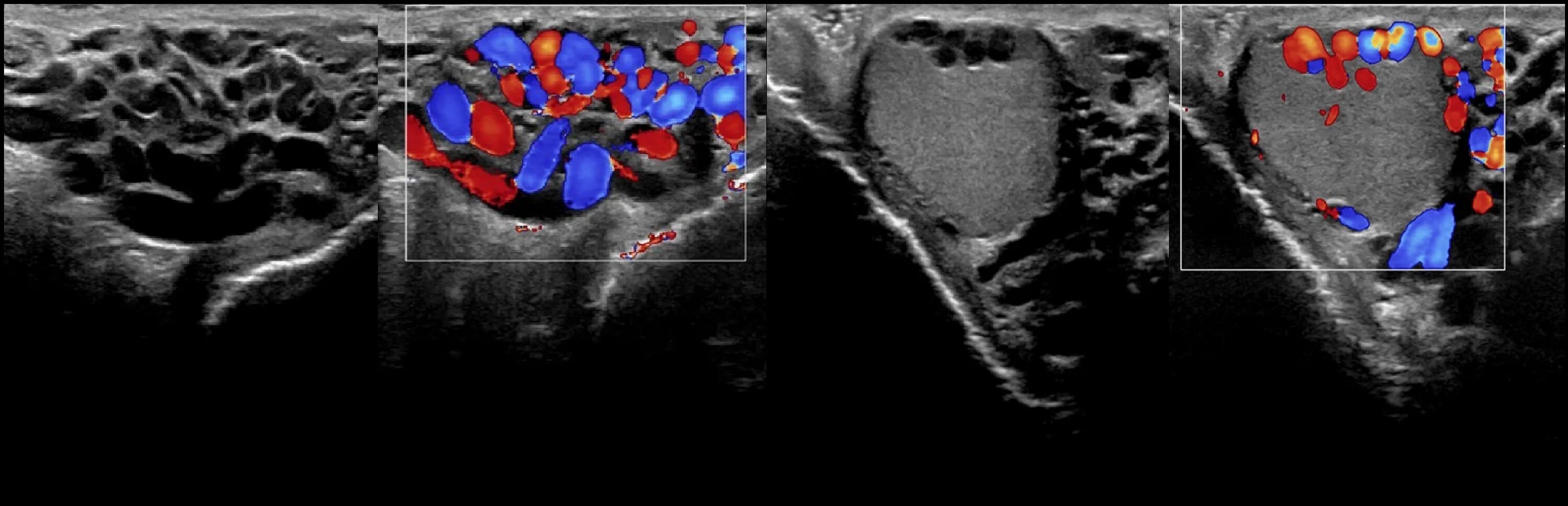 УЗИ мошонки варикоцеле 3 степени. Расширение вен семенного канатика на УЗИ. УЗИ сосудов семенного канатика. Вены семенного канатика норма УЗИ. Вена левого яичка
