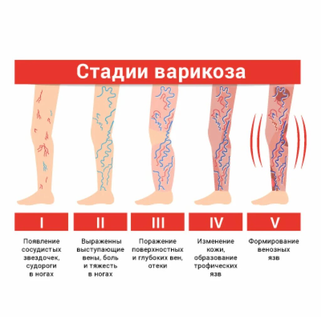 Трофические язвы варикоз. Варикозное расширение вен нижних конечностей сеточки. При варикозе какие виды. Варикозное расширение вен нижних. Гимнастика от варикоза на ногах.