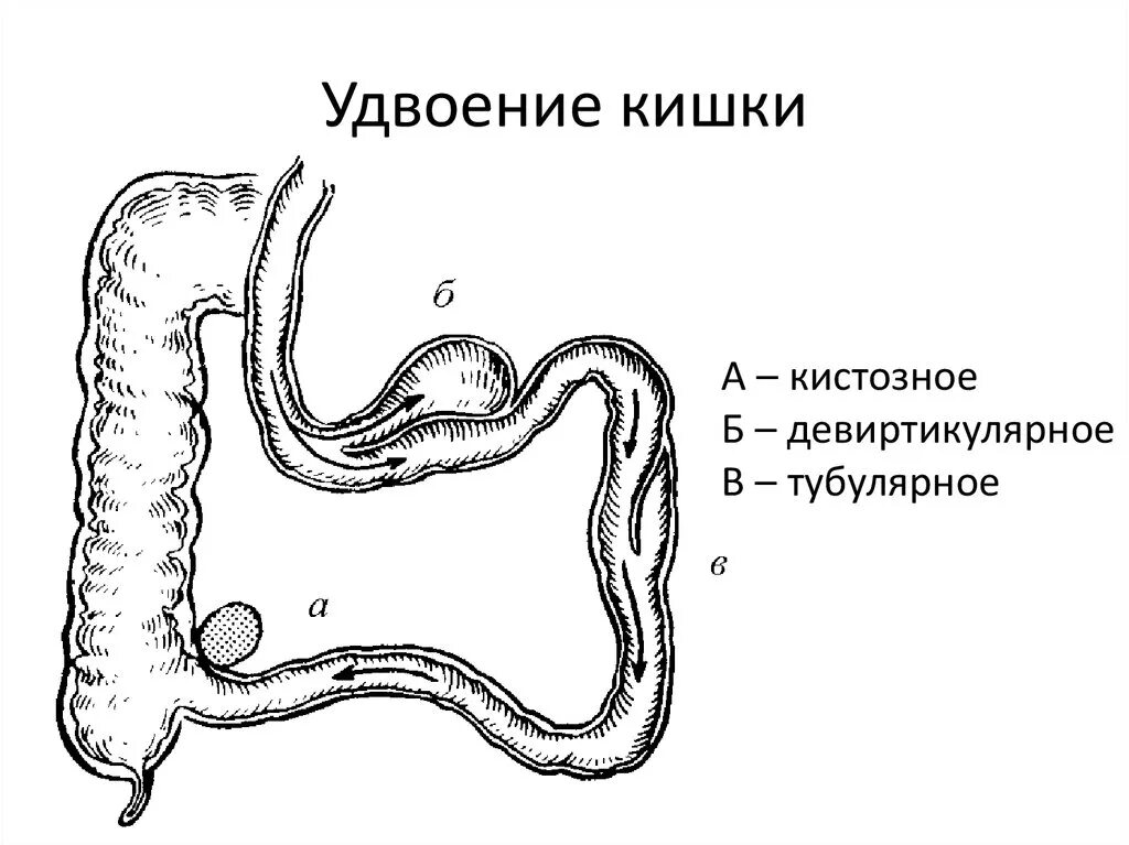 Трубчатые канальцы являющиеся слепыми выростами кишечника. Удвоение подвздошной кишки. удвоение двенадцатиперстной кишки. пороки развития тонкого кишечника. удвоение толстой кишки.