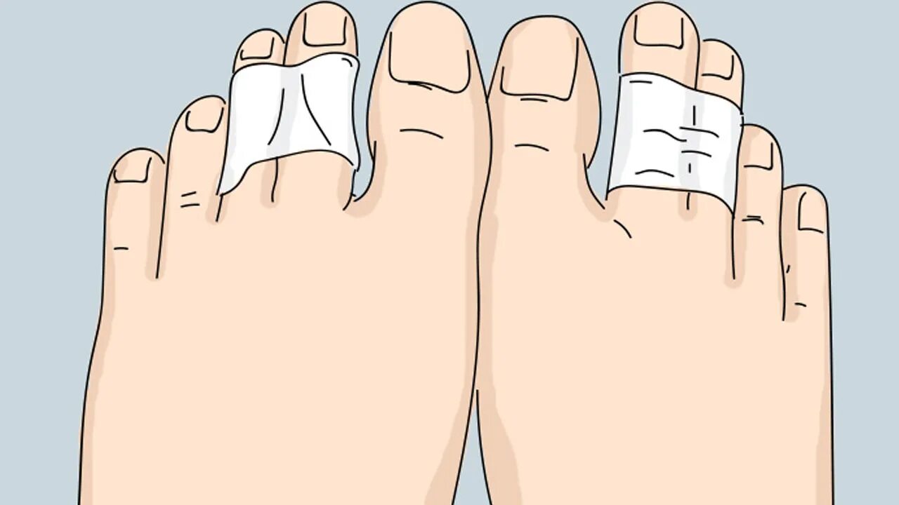 Вальгусная деформация шишка. Искривление пальцев ног. Палец на палец заходит. Указательный палец на ноге. Палец на палец заходит.