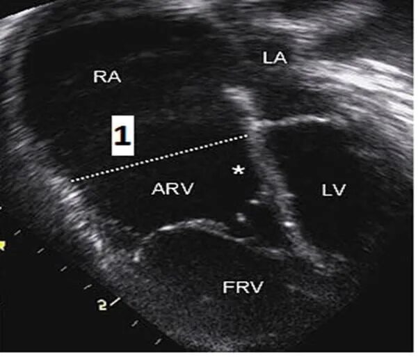 Фетальная эхокардиография плода. Аномалия эбштейна эхокардиография. Эхо аномалии. Эхо аномалии. Гипертрофия миокарда на эхокг.