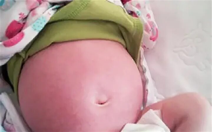 Ребенок 2 года вздуло живот. Пупок новорожденного пупочная грыжа. Ребенок 2 года вздуло живот. Ребенок 2 года вздуло живот. Животик новорожденного.