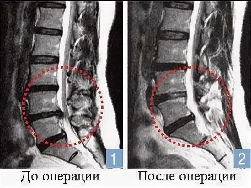 После удаления грыжи когда можно сидеть. Операция грыжи крестцового отдела позвоночника. реабилитация после операции межпозвоночной грыжи поясничного отдела. эндоскопическая дискэктомия грыжи позвоночника. межпозвоночная грыжа реабилитация после операции.