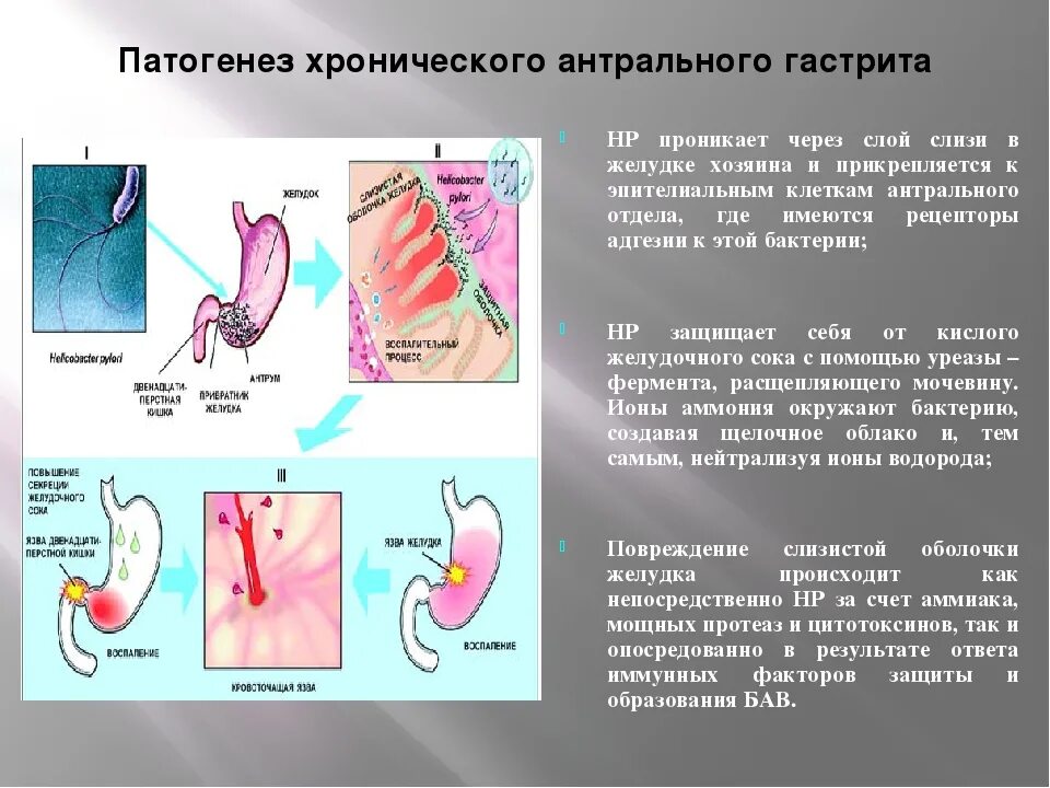 История хронического гастрита