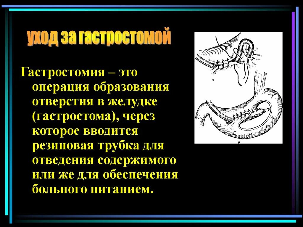 Гастростома алгоритм