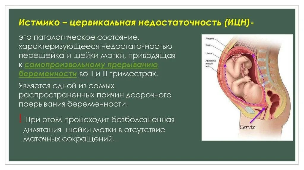 Истмико-цервикальная недостаточность. Цервикальная недостаточность при беременности. ИЦН при беременности во втором триместре. Можно достать до матки