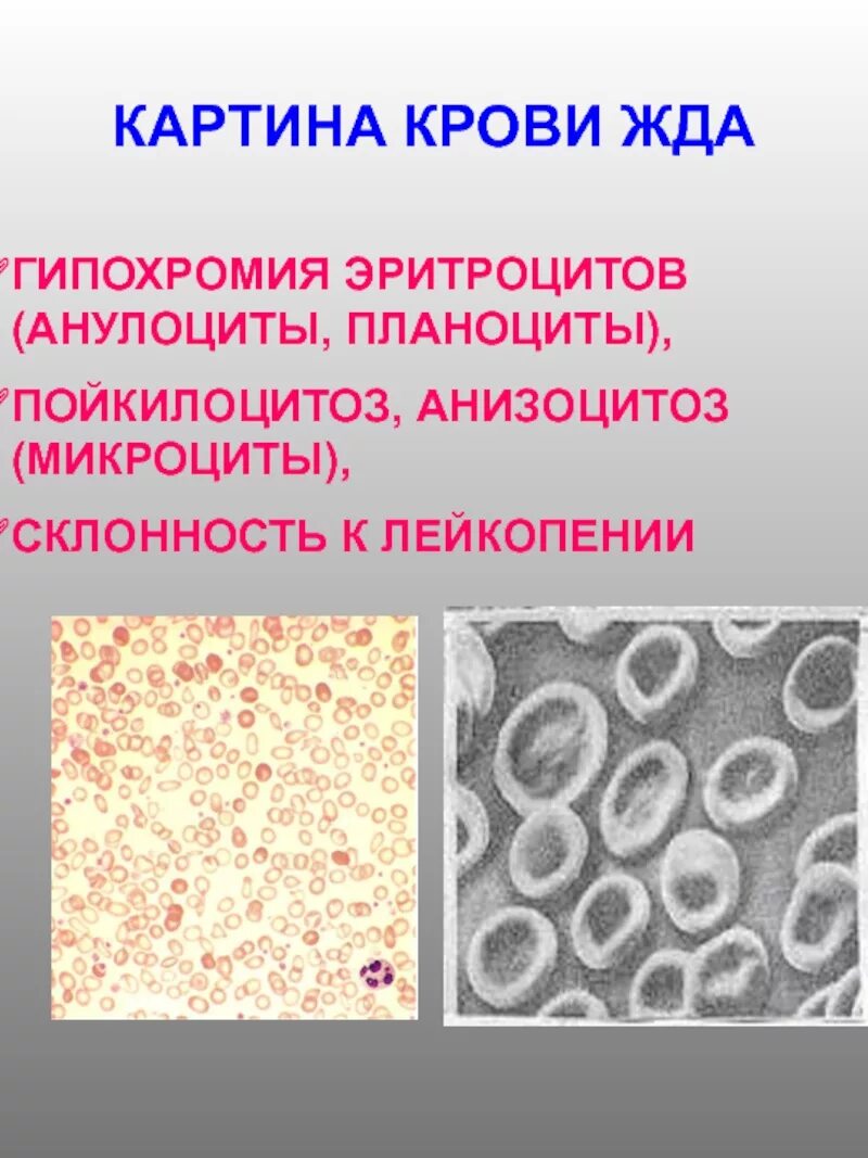 Гипохромия эритроцитов.  гипохромия  микроциты  анизоцитоз  пойкилоцитоз. железодефицитная анемия анизоцитоз. железодефицитная анемия картина крови. железодефицитная анемия пойкилоцитоз.