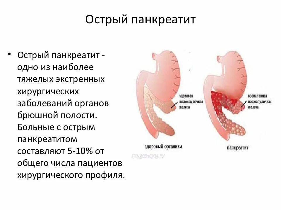 Хронические заболевания поджелудочной. Панкреатит презентация. Острый панкреатит презентация. Тяжелая форма острого панкреатита. Острый панкреатит слайд.