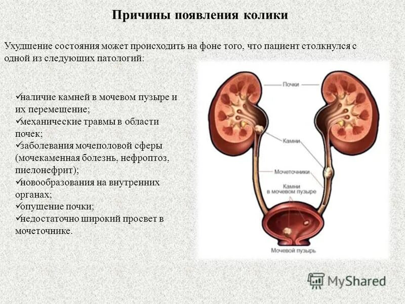 После мочевого. Почечная колика механизм возникновения. Почечная колика при мочекаменной болезни. Спастические сокращения мочеточника.