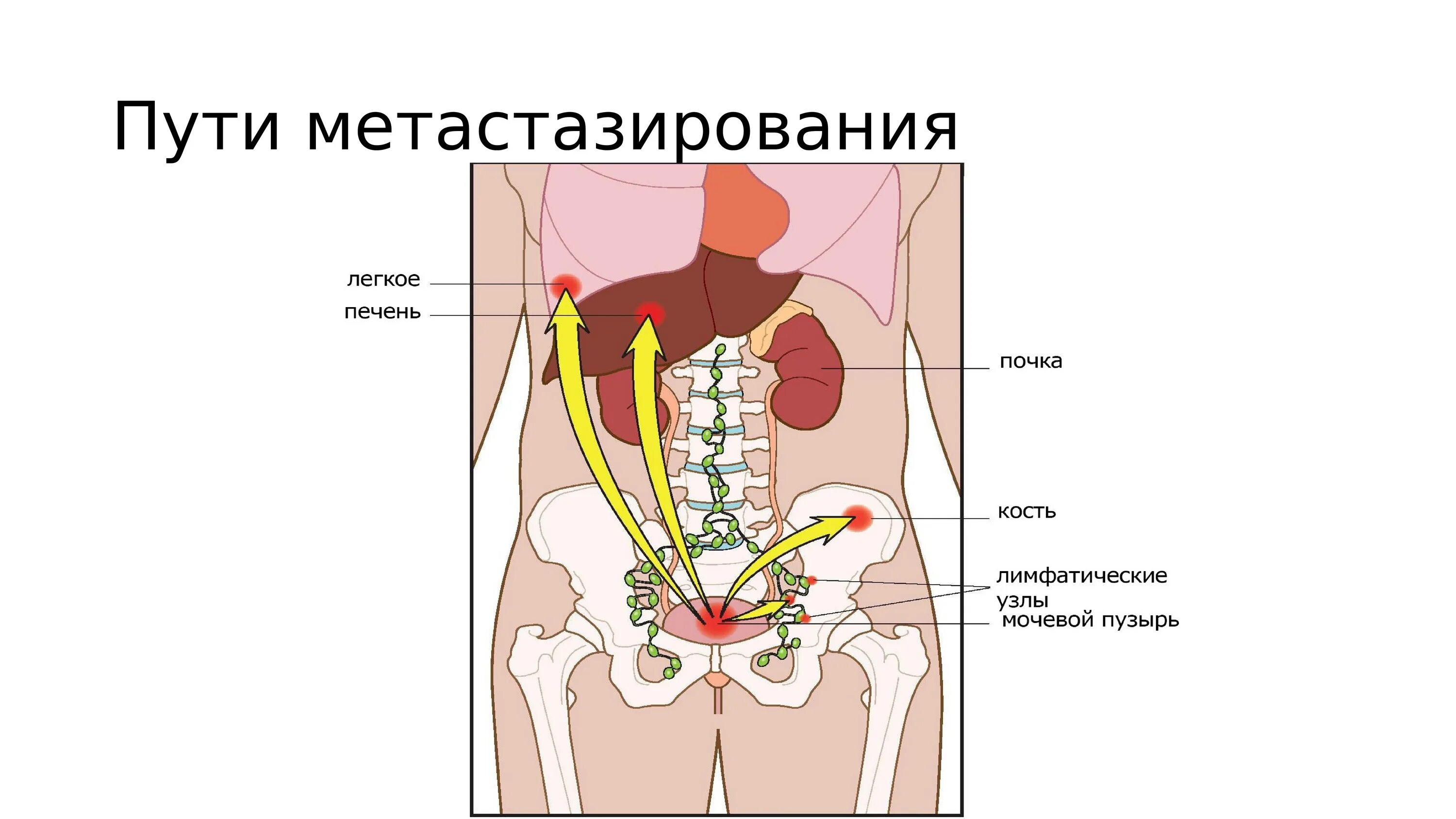 Пути метастазирования рака. Опухоли мочевого пузыря пути метастазирования. Пути распространения метастазов. Пути метастазирования опухолей. Имплантационный путь метастазирования.