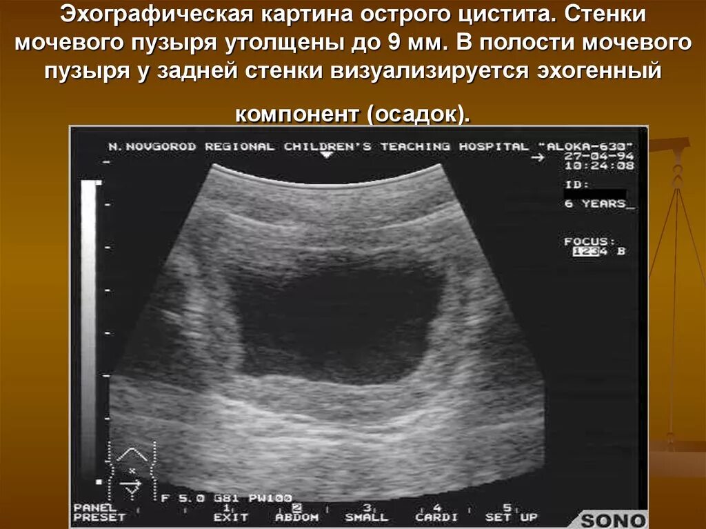 Норма стенки мочевого пузыря на УЗИ. Стенки мочевого пузыря утолщены УЗИ. УЗИ мочевого пузыря стенка утолщена протокол. Стенки мочевого пузыря на УЗИ анатомия. Гипотония мочевого