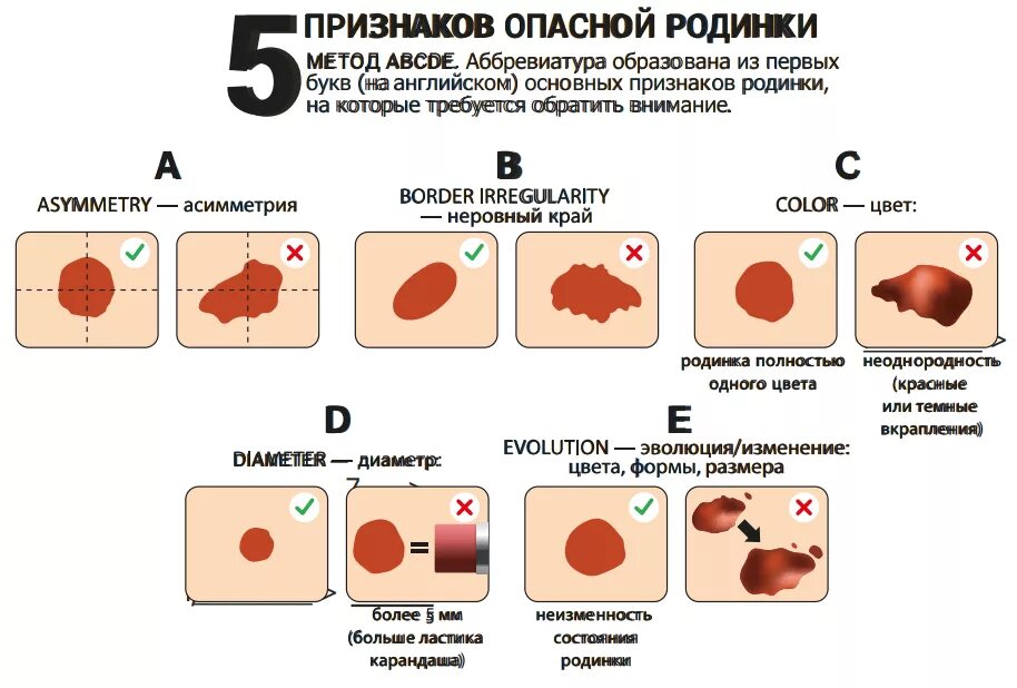 Классификация АВСД меланома. Изменение формы родинки. Что означает злокачественная