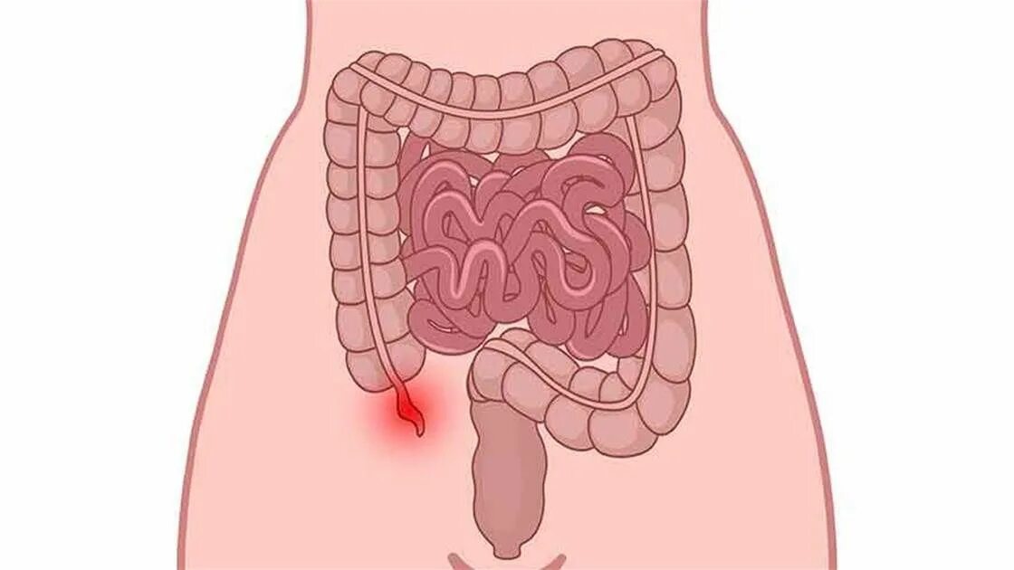 Аппендикс какой орган