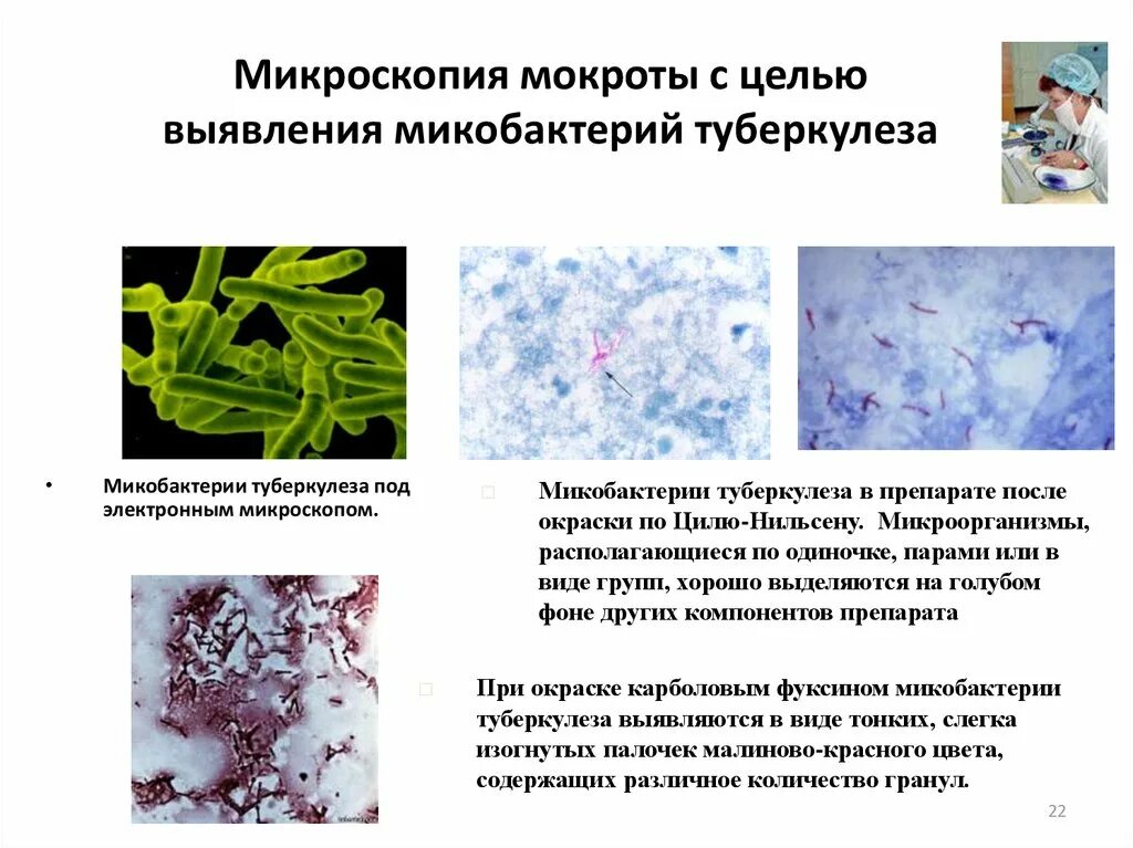 Реакция мокроты. Микобактерии туберкулеза микроскопия мокроты. Окраска мазка микобактерии туберкулеза. Микроскопическое исследование мокроты при туберкулезе. Микобактерии туберкулеза при микроскопии.