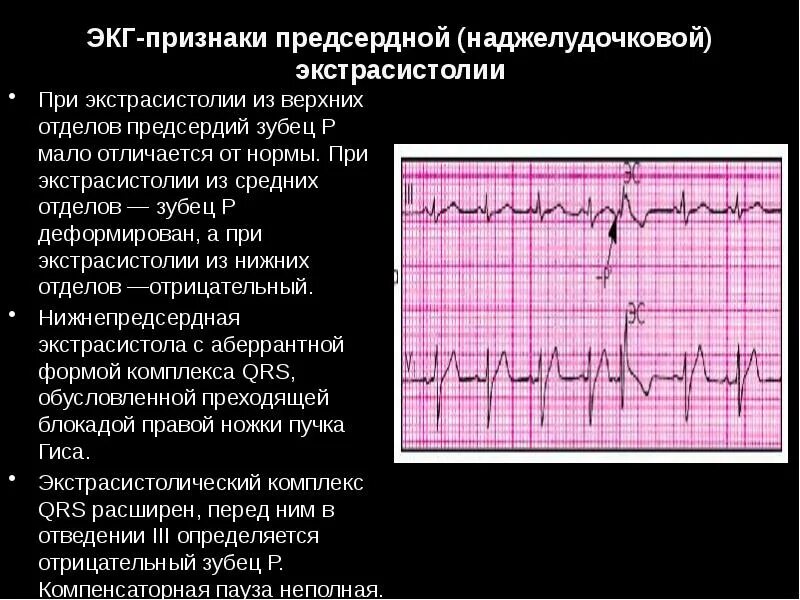 Желудочковые экстрасистолы что это такое у взрослых. Наджелудочковая экстрасистолия экг критерии. экг критерии наджелудочковой экстрасистолы?. суправентрикулярная экстрасистолия экг критерии. экг монотопные желудочковые экстрасистолы.