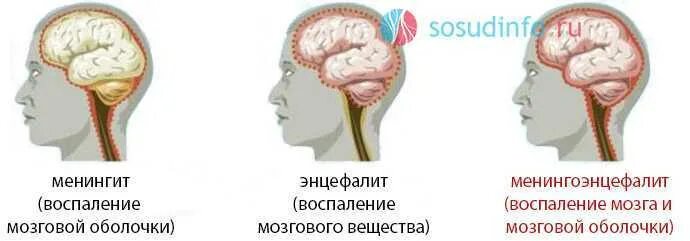 Менингит воспаление оболочек головного мозга. Менингит энцефалит и менингоэнцефалит. Менингоэнцефалит, воспаление головного мозга. Воспаление мозговых оболочек энцефалит. Поражение оболочек мозга