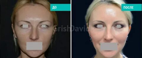 Липофилинг грудных желез до и после