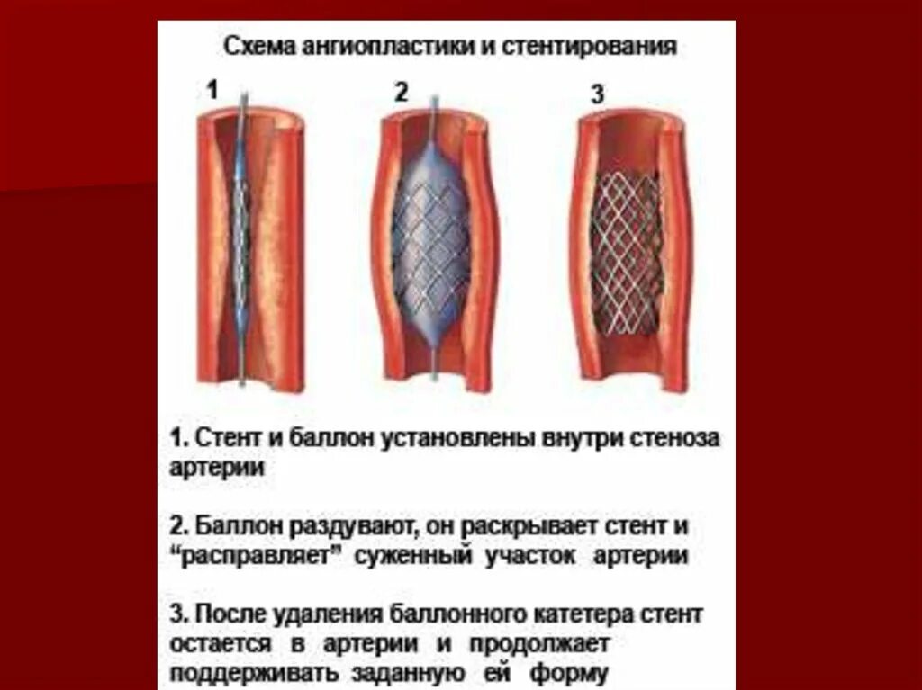 Баллонная дилатация и ангиопластика. Баллонной дилатации стентирование. Баллонная ангиопластика и стентирование. Стентирование коронарных артерий. Как ставят стент