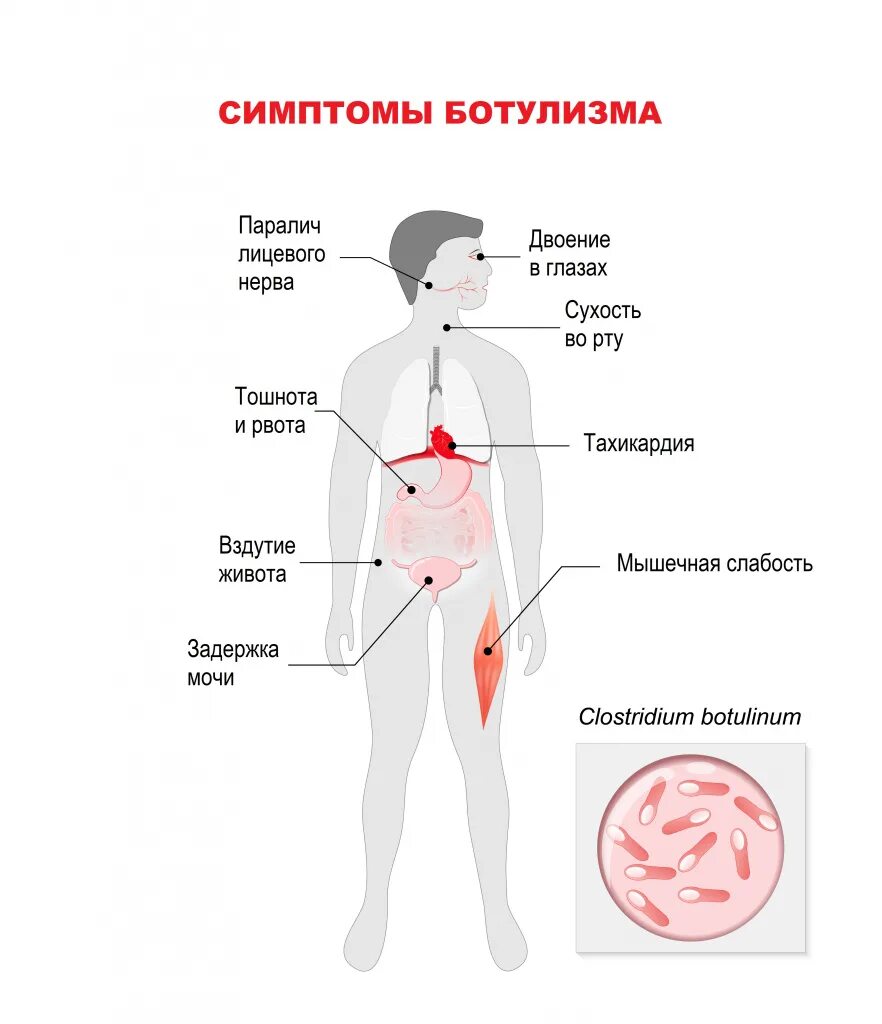 Симптомы ботулизма у человека. Основные клинические симптомы ботулизма. Ботулизм симптомы. Ботулизм клиническая картина. Симптомы ботулизм отравления.