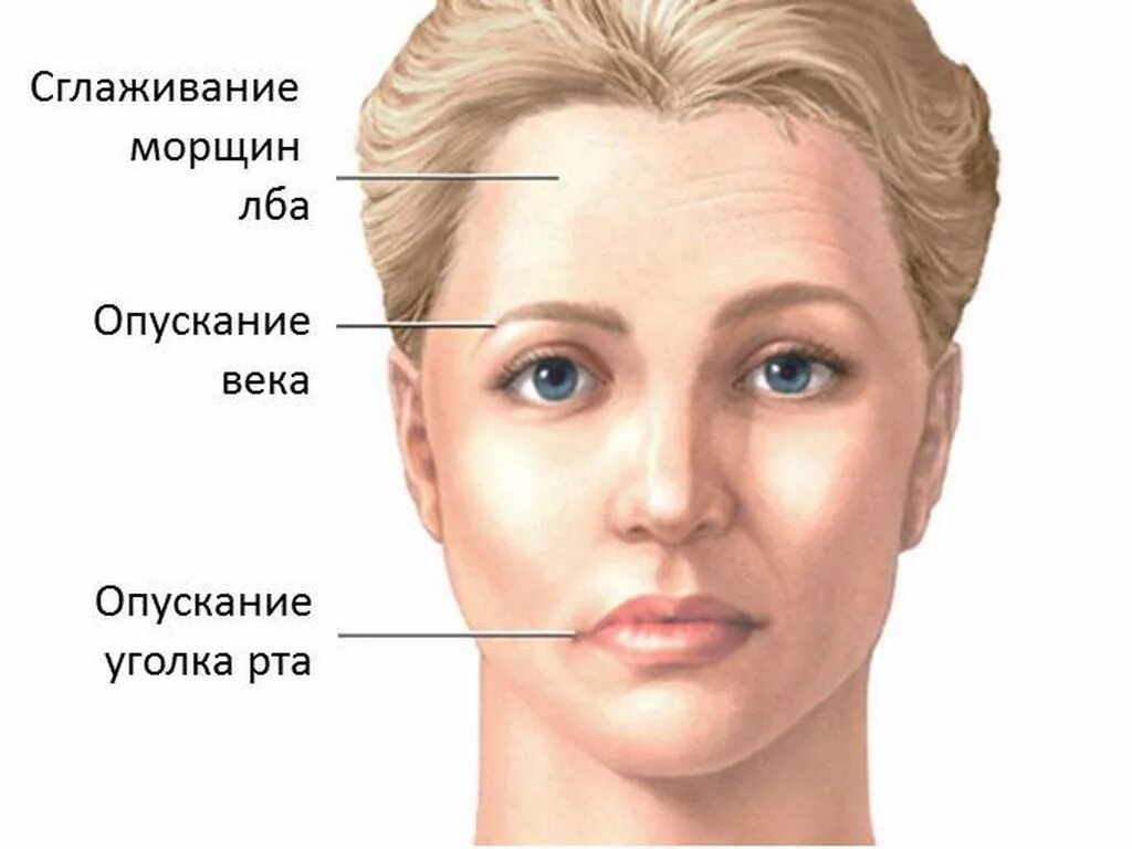 Сводить левую сторону. Асимметрия лица. Неврит тройничного лицевого нерва. Нейропатия лицевого нерва.