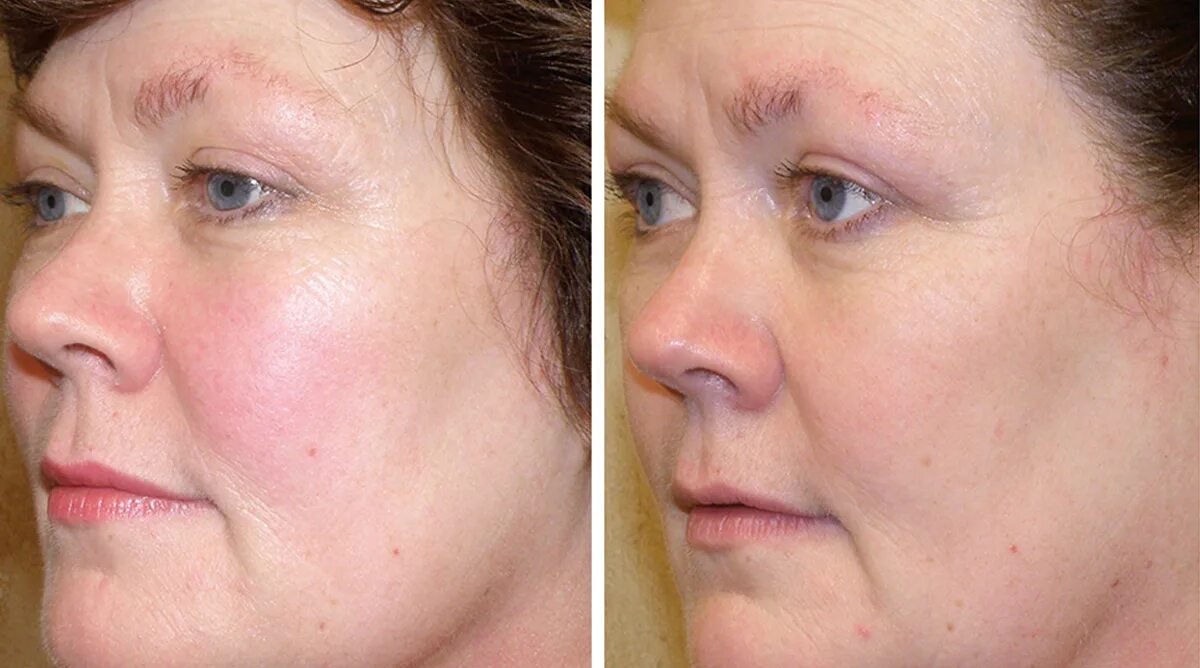 Омоложение сосудов. Фотоомоложение bbl forever young. аппарат sciton bbl.