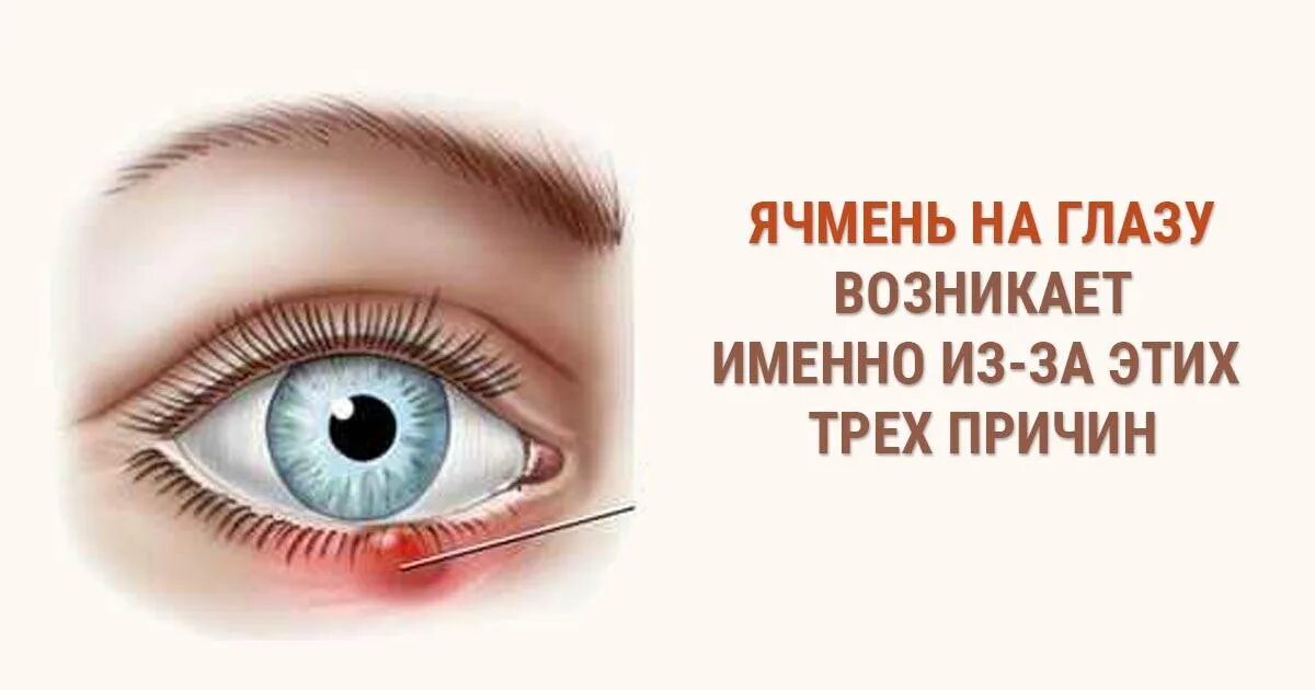 Ячмень как быстро вылечить в домашних