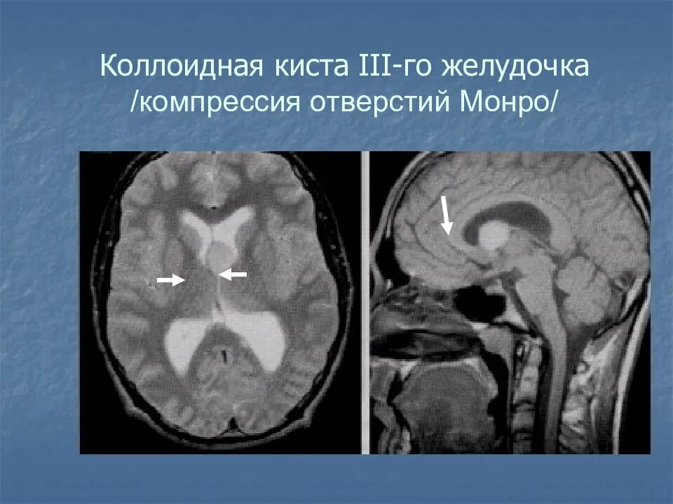 Киста желудочка головного мозга. Киста желудочка головного мозга мрт. Киста III желудочка головного мозга. Киста желудочка головного мозга кт. Коллоидная киста 3 желудочка.