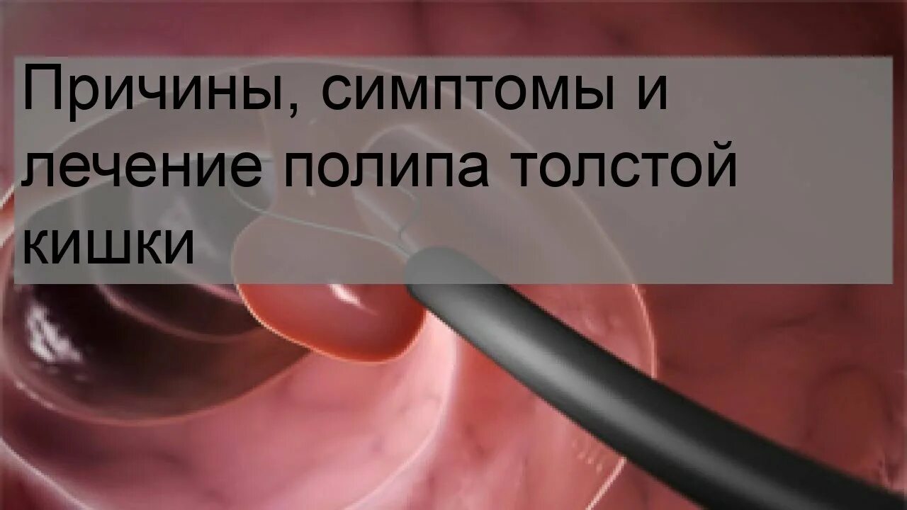 Код мкб полип толстого кишечника. Полип толстой кишки мкб 10. полипы толстого кишечника мкб. полипы толстого кишки мкб. полип толстой кишки код мкб 10.
