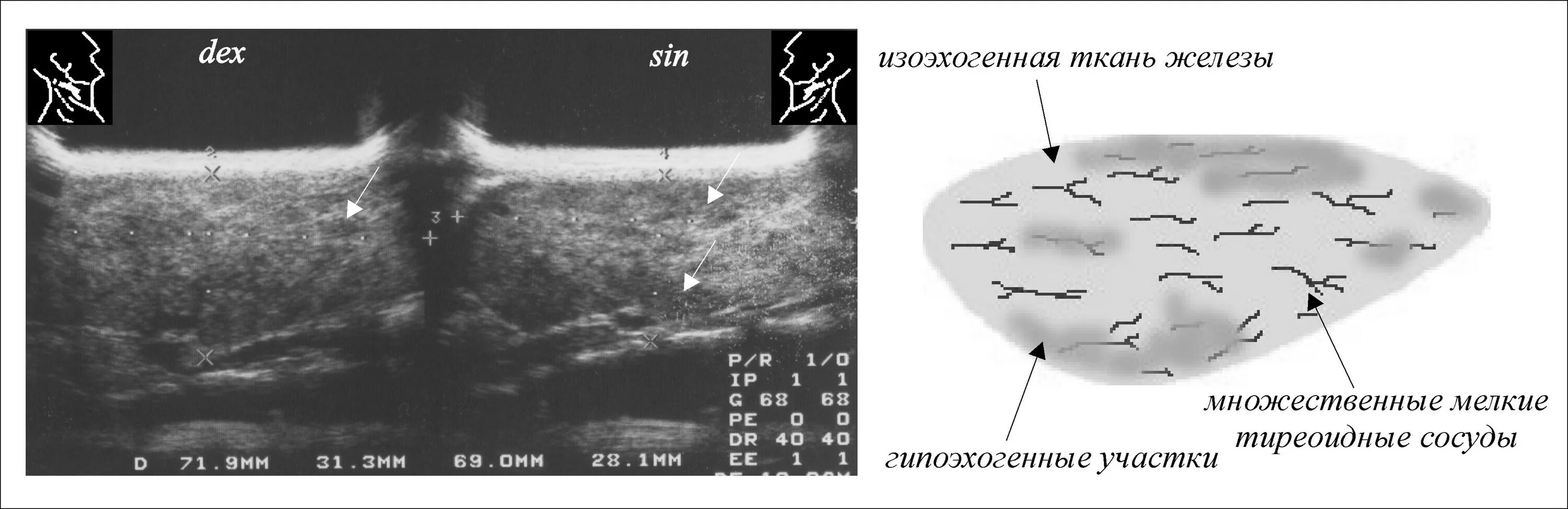 Аваскулярное образование в печени. Изоэхогенное образование щитовидной железы УЗИ. Изоэхогенный узел щитовидной железы что это такое. Гипоэхогенный узел щитовидной железы на УЗИ. Эхогенность изоэхогенная что это такое печени.
