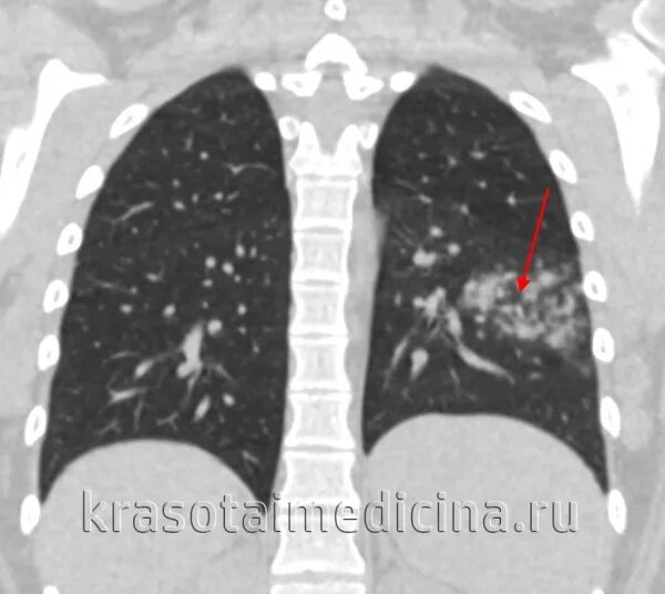 Полисегментарная пневмония кт. Сегментарная плевропневмония на кт. Плевропневмония легкого кт. Вирусная пневмония на кт. Эозинофильная пневмония кт.
