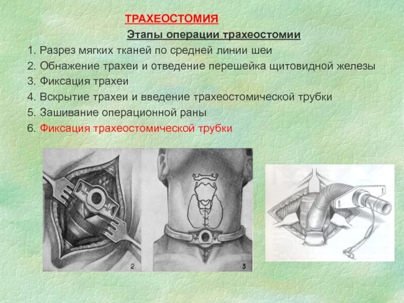 Этапы трахеостомии топографическая анатомия. Трахеостомия топографическая анатомия этапы операц. Верхняя трахеотомия этапы операции. Методика наложения трахеостомы алгоритм. Назовите этапы операции