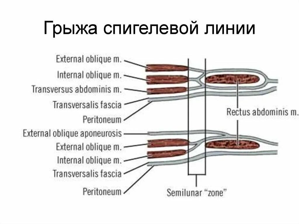 Грыжа спигелиевой линии. Спигелиевая линия анатомия. спигелиевая линия живота анатомия. грыжа спигелиевой линии живота.