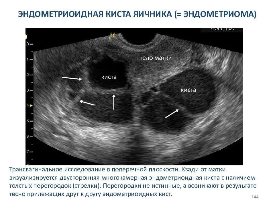 Эндометриоидная киста яичника на УЗИ. Мультилокулярная киста яичника. Эндометриоидная киста яичника диагноз. Эндометриоидная киста яичников симптомы. Киста яичника с перегородками