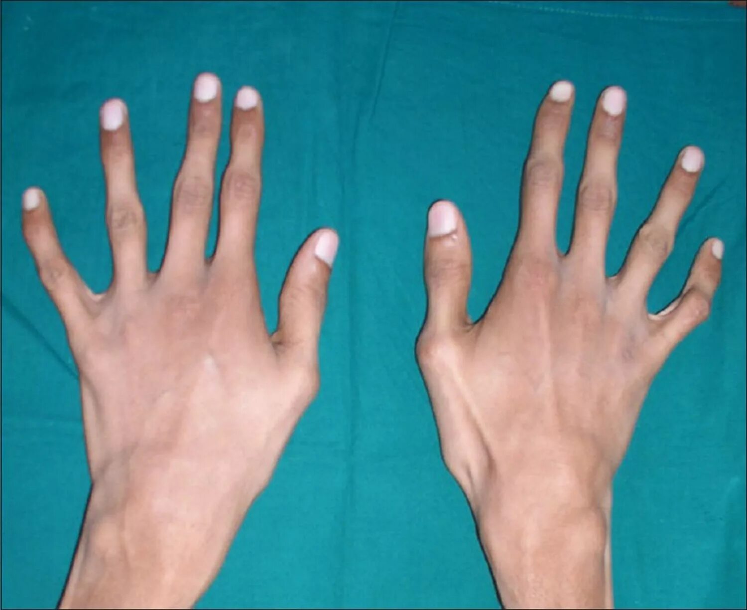 Пальцы стали толще. Синдром Марфана (арахнодактилия). Арахнодактилия симптомы. Арахнодактилия паучьи пальцы.
