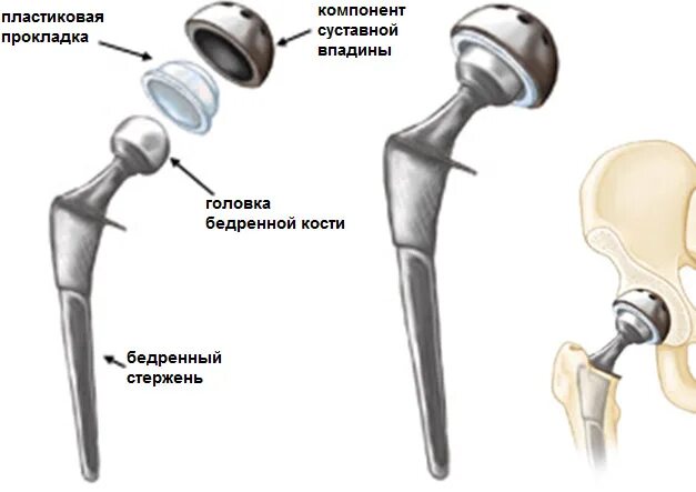 Замена тазобедренного сустава под каким наркозом. Перелом шейки бедра эндопротезирование тазобедренного сустава. эндопротез тазобедренного сустава depuy. эндопротез тазобедренного сустава smith nephew.