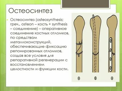 Остеосинтез классификация