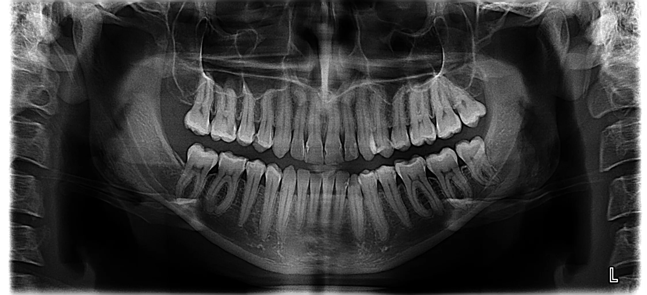 Снимок зубов видное. Ортопантомограмма кариес. Снимок ортопантомограмма. Рентген зубов панорамный.
