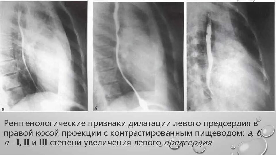 Признаки дилатации левого предсердия. Начальная дилатация ЛП. Дементация левого предсердия. Дилатация левого предсердия причины. Дилатация полостей предсердий